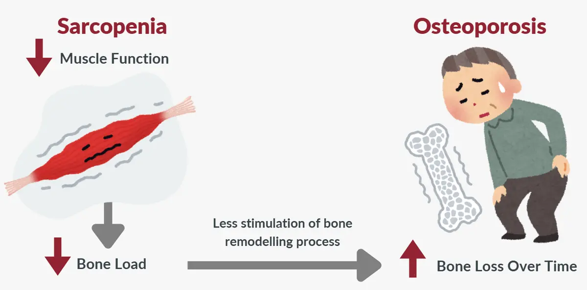 Connection between Sarcopenia and Osteoporosis